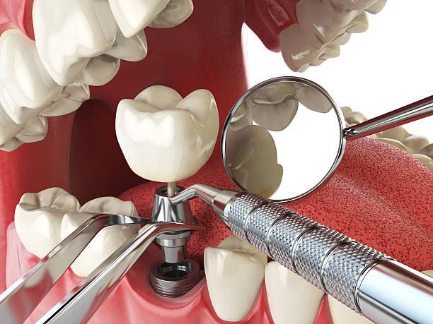 Best Urgent Care for Lost Fillings or Crowns in Locust Valley, NY